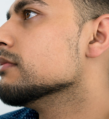 Avant greffe de barbe